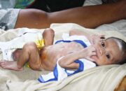 Seorang Bayi Lahir dengan Usus Menggantung di Luar Perut