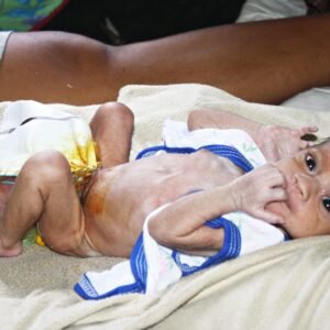 Seorang Bayi Lahir dengan Usus Menggantung di Luar Perut - Kabar Harian Bima