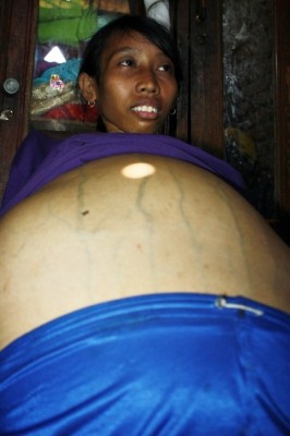Karmani dengan kondisi perut yang semakin membesar. Foto: Bin