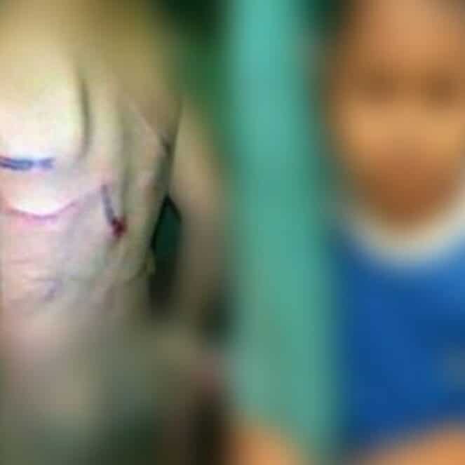 LPA Tangani Bocah Korban Aniaya, Besok Bapaknya Dilapor Polisi