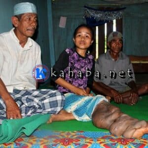 Derita Kaki Gajah, Susanti Ingin Sembuh