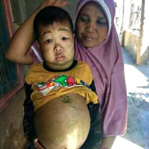 Farlin 3 Tahun Menderita, Badannya Terus Membengkak, Panas dan Sering Pingsan