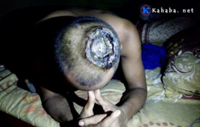 Pria Miskin ini Diserang Tumor Ganas, Kepalanya Berlubang dan Keluarkan Nanah - Kabar Harian Bima