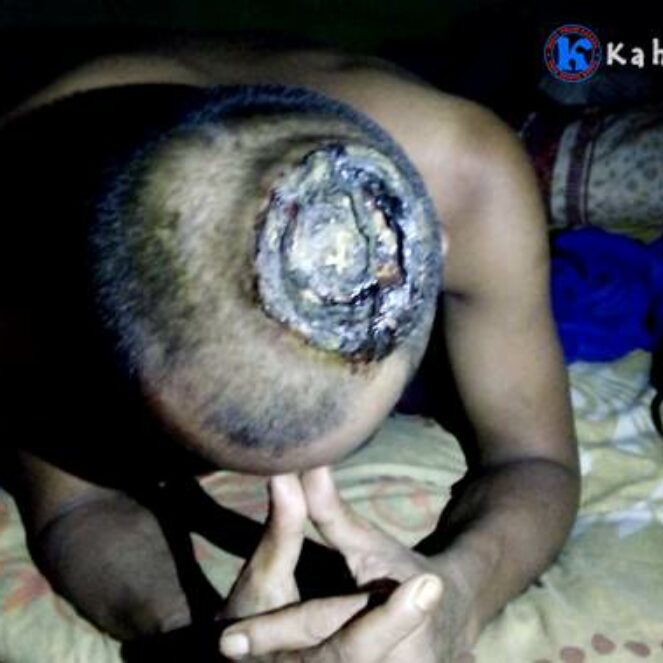 Pria Miskin ini Diserang Tumor Ganas, Kepalanya Berlubang dan Keluarkan Nanah