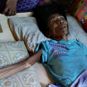 Badan Tinggal Tulang, Saniasah Idap Kanker Anus dan Butuh Bantuan