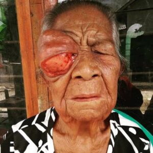 Lama Tak Tertangani, Mata Nenek Marlia Diserang Tumor Ganas