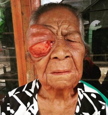 Lama Tak Tertangani, Mata Nenek Marlia Diserang Tumor Ganas - Kabar Harian Bima