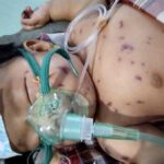 Didiagnosa Miningitis, Zaskia Terkapar di RS dan Kesulitan Biaya - Kabar Harian Bima