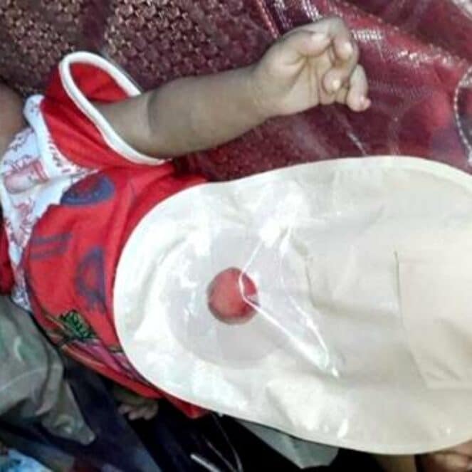 Lahir Tanpa Anus, Bayi di Desa Bre Butuh Biaya Operasi