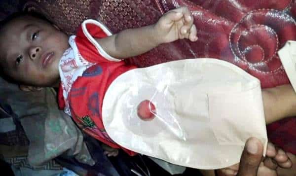 Lahir Tanpa Anus, Bayi di Desa Bre Butuh Biaya Operasi - Kabar Harian Bima