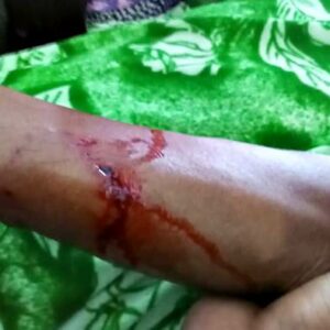 7 Warga di Wawo Diserang Anjing Diduga Terjangkit Rabies - Kabar Harian Bima